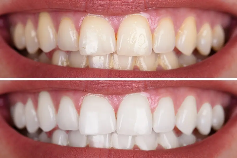 LED teeth whiten